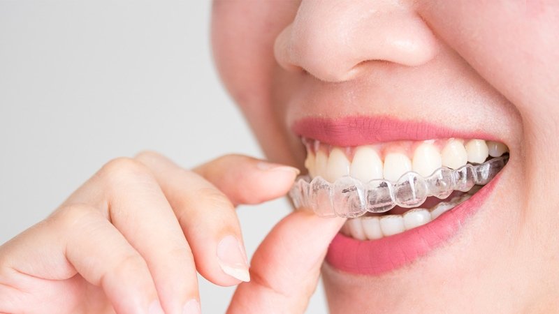Make Teeth Straightening at Home Accessible with Affordable Clear Aligners